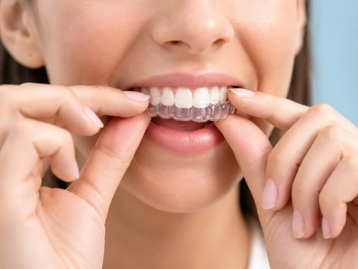 Woman placing clear aligners on her teeth